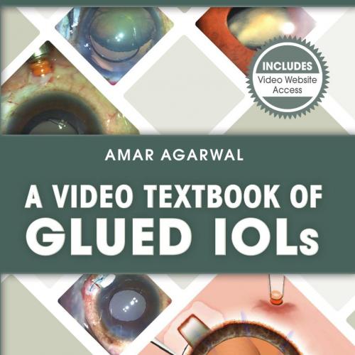 Video Textbook of Glued IOLs, A