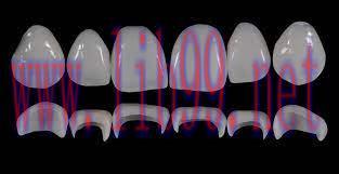 [AME]Gidedental Prosthetic Rehabilitation on Natural Teeth &ndash; Predictable, Esthetic and Systemat...