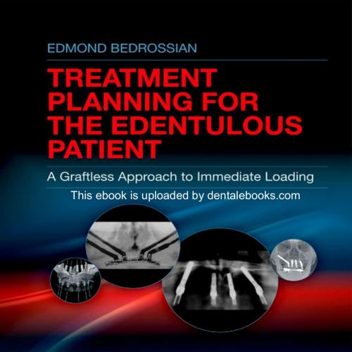 Implant Treatment Planning for the Edentulous Patient