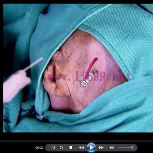 [Media]Flaps and Grafts in Dermatologic Surgery 2nd Edition Videos