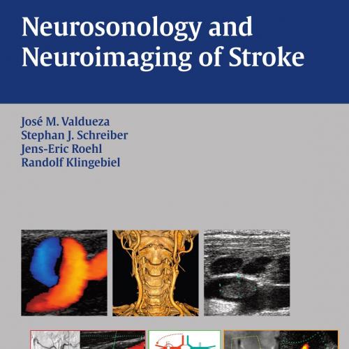 Neurosonology and Neuroimaging of Stroke