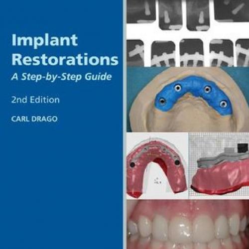 Implant Restorations A Step-by-Step Guide, 2nd Edition