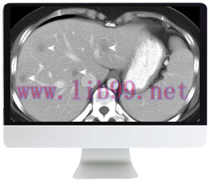 [AME]ARRS SAR Disease-Focused Panels: Cancer Imaging and Reporting Guidelines 2021 (CME VIDEOS)