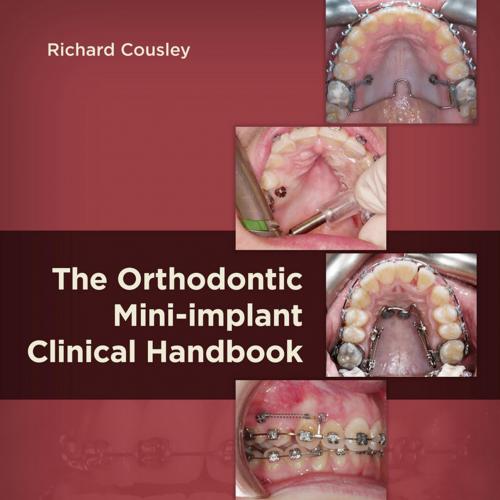 Orthodontic Mini-implant Clinical Handboo, The - Richard R.J. Cousley