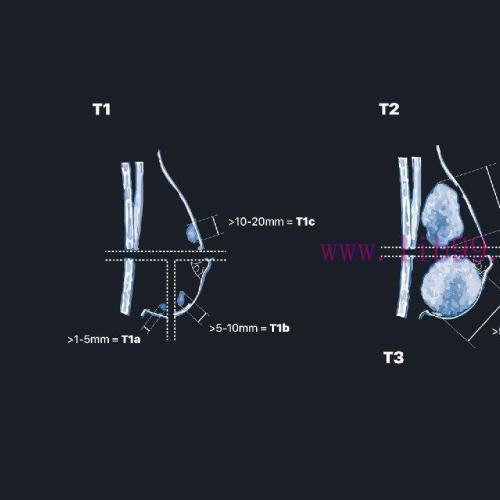 [AME]MRIOnline Mastery Series: Evaluation of Newly Diagnosed, Pre-Operative Breast Cancer Patie...