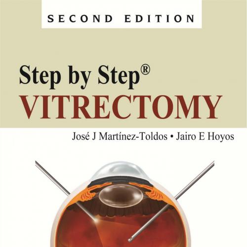Step by Step-Vitrectomy,2nd Edition