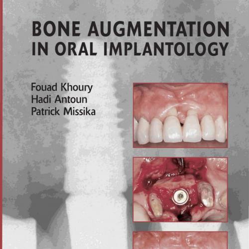 Bone Augmentation In Oral Implantology