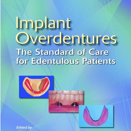 Implant Overdentures The Standard of Care for Edentulous Patients