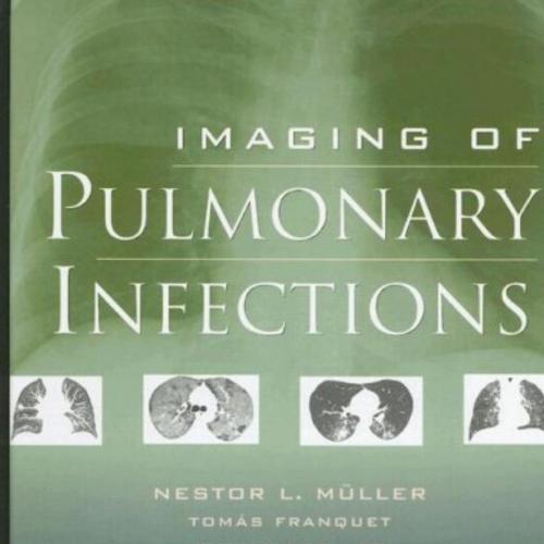 Imaging of Pulmonary Infections