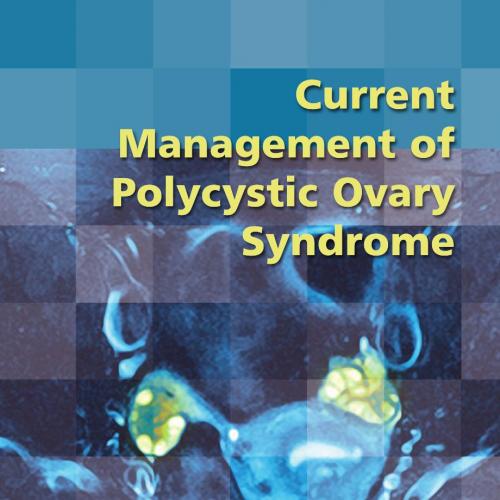 Current Management of Polycystic Ovary Syndrome