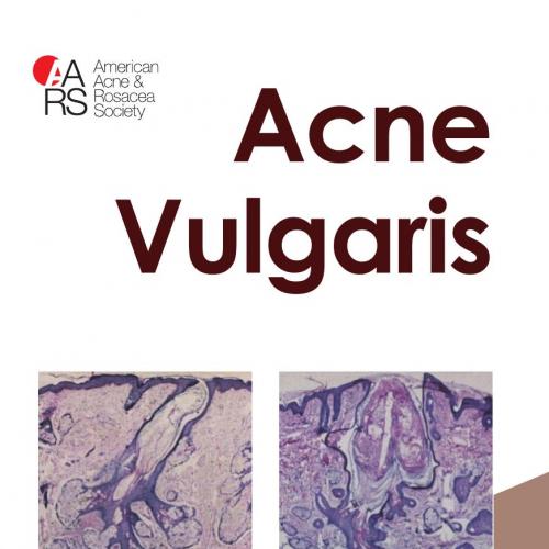 Acne Vulgaris