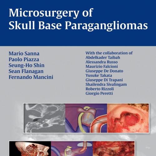 Microsurgery of Skull Base Paragangliomas - Sanna, Mario; Paolo, Piazza; a.o_