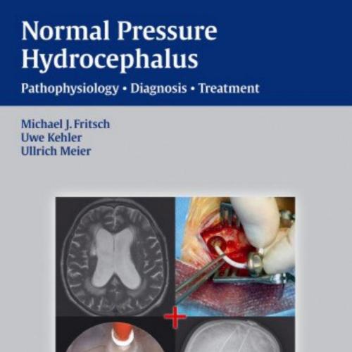 NPH-Normal Pressure Hydrocephalus,Pathophysiology-Diagnosis-Treatment