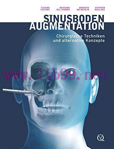 [AME]Sinusbodenaugmentation: Chirurgische Techniken und alternative Konzepte (German Edition) (...