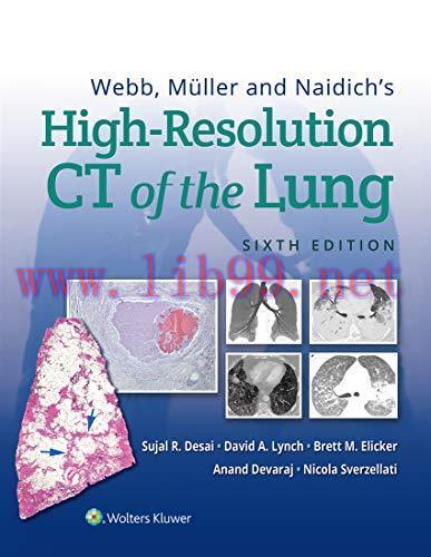 [AME]Webb, M&uuml;ller and Naidich&rsquo;s High-Resolution CT of the Lung, 6ed (azw3+Converted PDF)