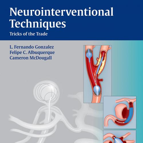 Neurointerventional Techniques