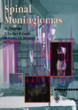 [PDF]Spinal Meningiomas