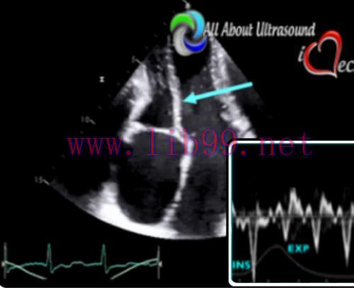 [AME]Mastering Constrictive Pericarditis - AllAboutUltrasound 2022 (Complete HTML)