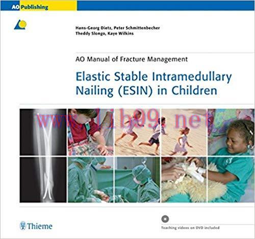 [PDF]Elastic Stable Intramedullary Nailing (ESIN) in Children