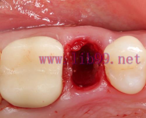 [AME]Gidedental Extraction Socket &ndash; Preservation/Grafting; Immediate vs Delayed Implants; Ponti...