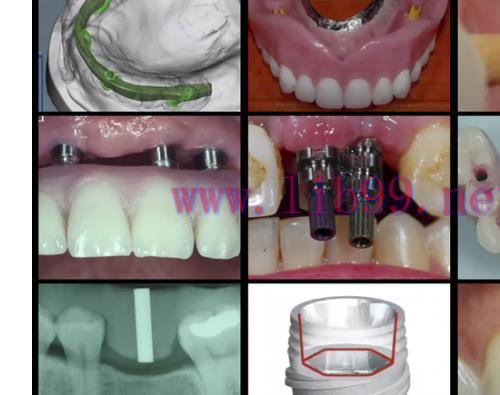 [AME]Gidedental A-Z in Restorative Implant Dentistry (CME VIDEOS)