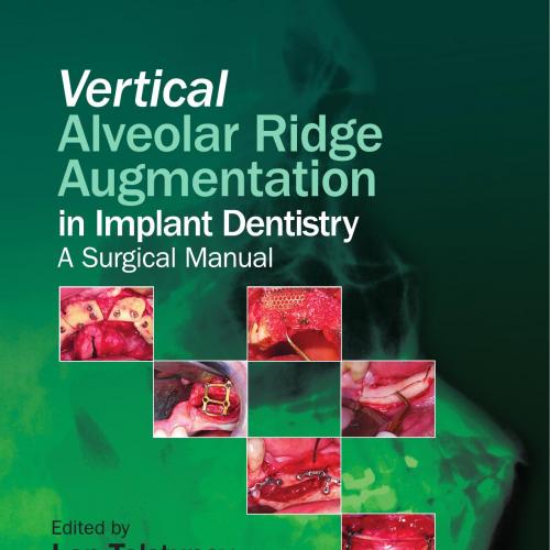 Vertical Alveolar Ridge Augmentation in Implant Dentistry