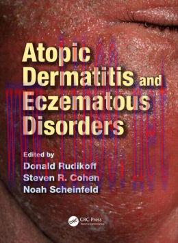 [AME]Atopic Dermatitis and Eczematous Disorders