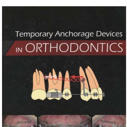 Temporary Anchorage Devices in Orthodontics