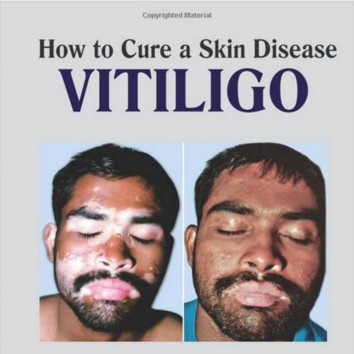 How to Cure a Skin Disease Vitiligo