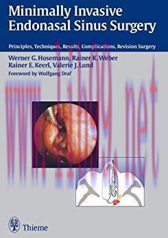 [PDF]Minimally Invasive Endonasal Sinus Surgery