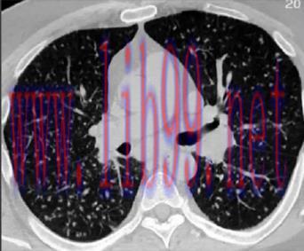 [AME]MRIOnline Imaging Mastery Series: Micronodules 2021 (CME VIDEOS)