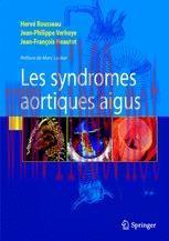 [PDF]Syndromes aortiques aigus