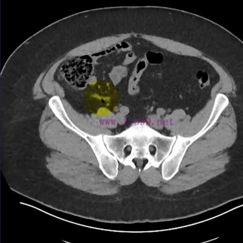 [AME]MRIOnline Imaging Mastery Series: Appendix 2021 (CME VIDEOS)