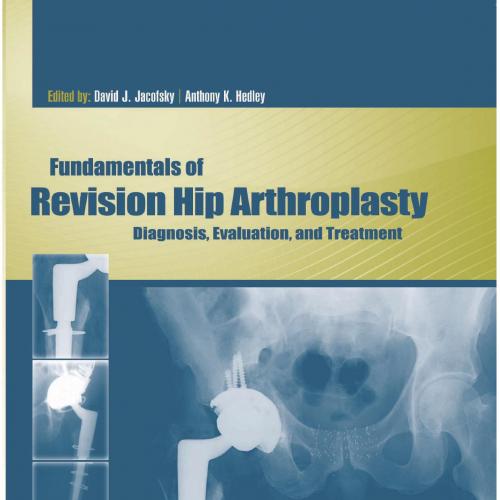 Fundamentals of Revision Hip Arthroplasty-Diagnosis, Evaluation, and Treatment