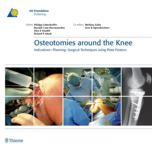 Osteotomies around the Knee Indications-Planning-Surgical Techniques using Plate Fixators
