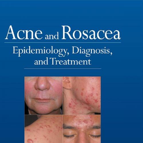 Acne and Rosacea_ Epidemiology, Diagnosis and Treatment