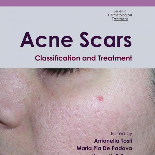 Acne Scars Classification and Treatment - Antonella Tosti, Maria De Padova, Kenneth Beer
