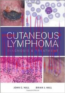[AME]Cutaneous Lymphoma : Diagnosis and Treatment