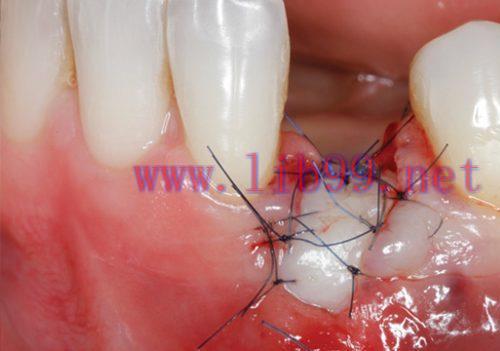 [AME]Gidedental Soft Tissue Management around Natural Teeth and Dental Implants 2020 (CME VIDEO...