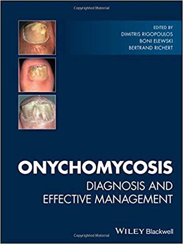 Onychomycosis Diagnosis and Effective Management