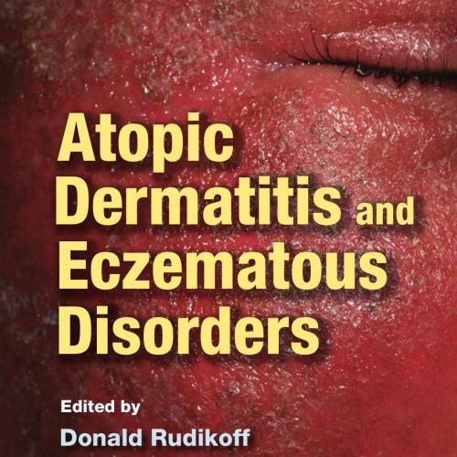 Atopic Dermatitis and Eczematous Disorders
