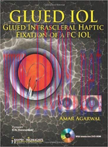 [PDF]GLUED IOL: Glued Intrascleral Haptic Fixation of a PC IOL [Agarwal Amar]